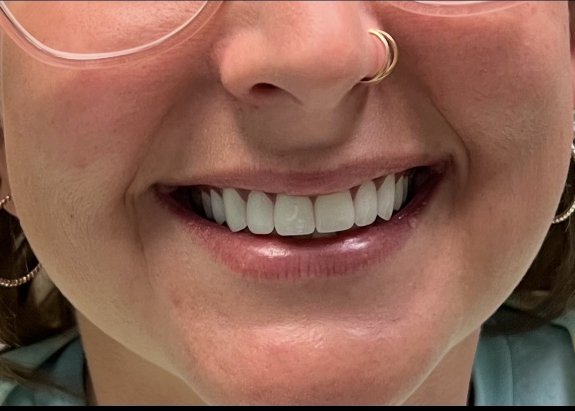 After smile transformation