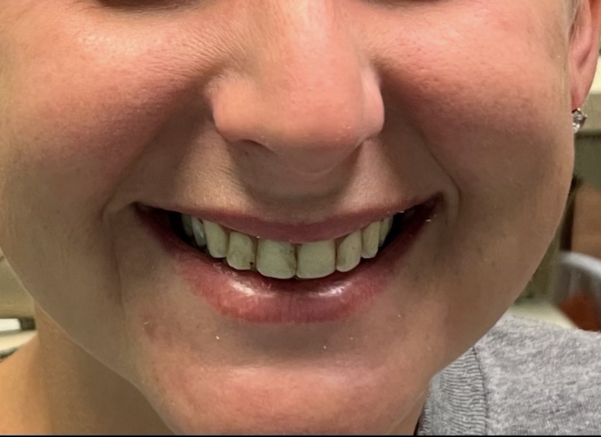 Before smile transformation